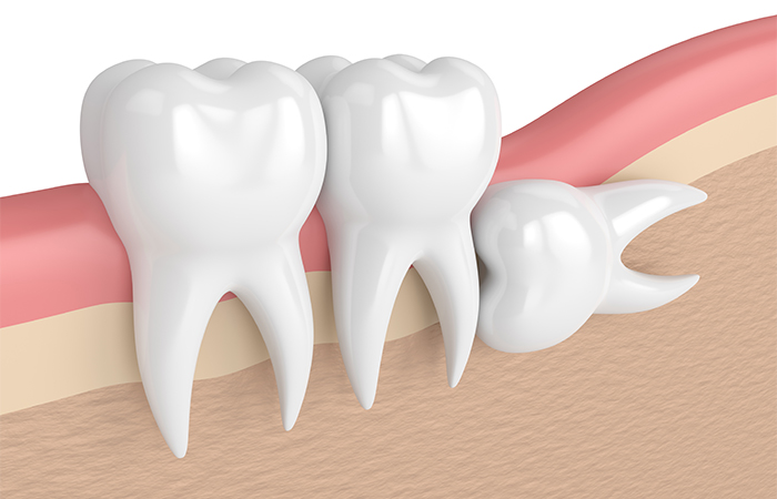 抜歯をおすすめする親知らず